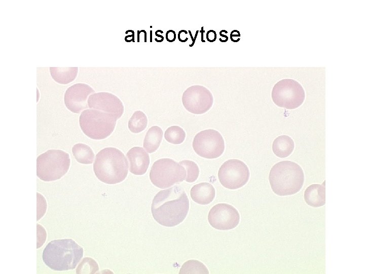 anisocytose 