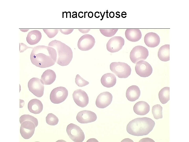 macrocytose 