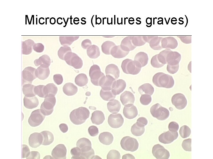 Microcytes (brulures graves) 
