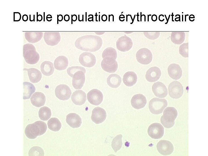 Double population érythrocytaire 