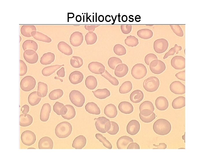 Poïkilocytose 