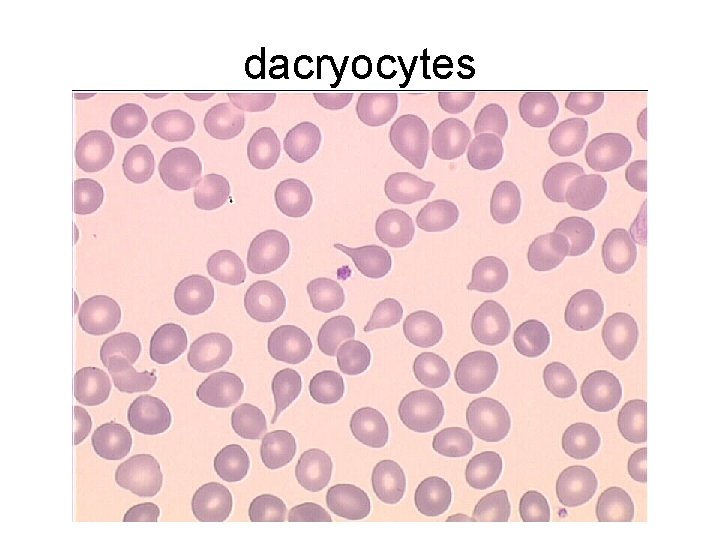 dacryocytes 