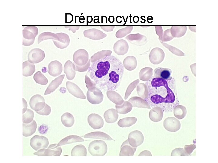 Drépanocytose 