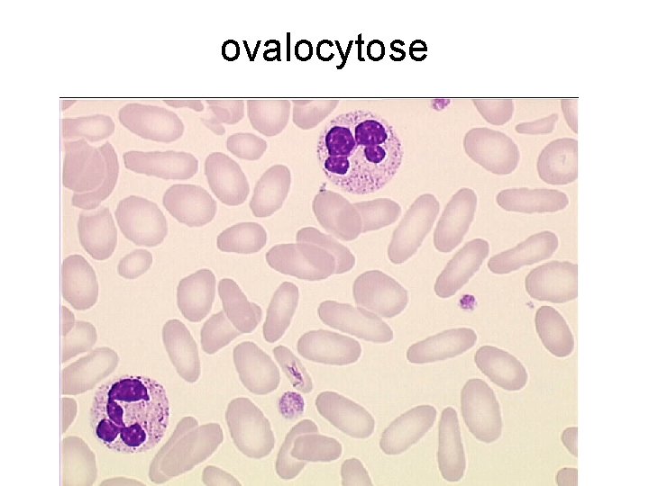 ovalocytose 