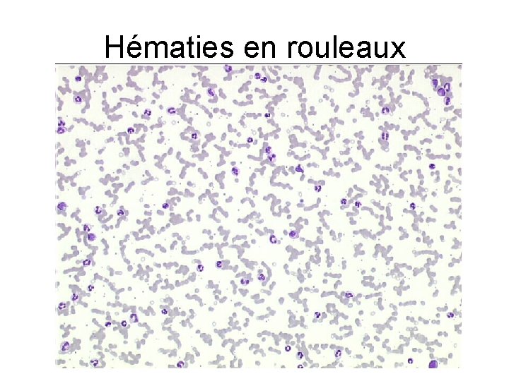 Hématies en rouleaux 