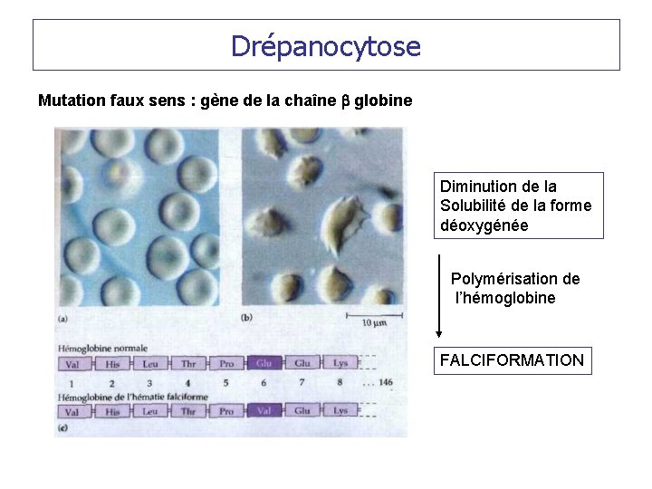 Drépanocytose Mutation faux sens : gène de la chaîne b globine Diminution de la