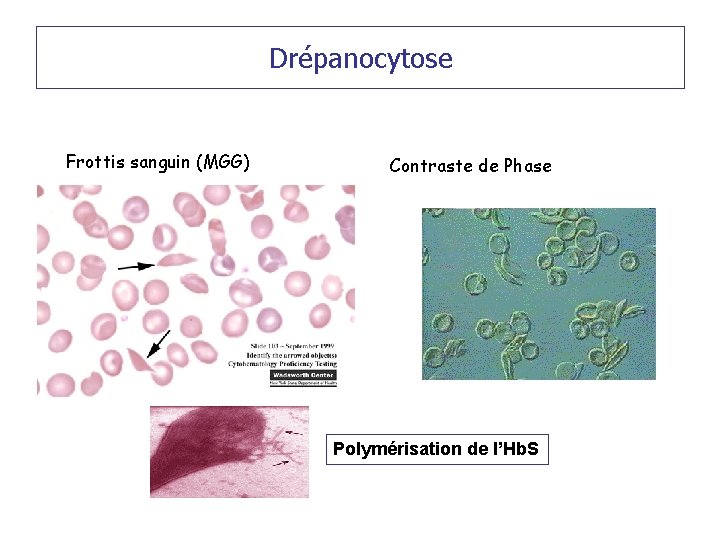Drépanocytose Frottis sanguin (MGG) Contraste de Phase Polymérisation de l’Hb. S 