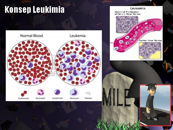 Konsep Leukimia 