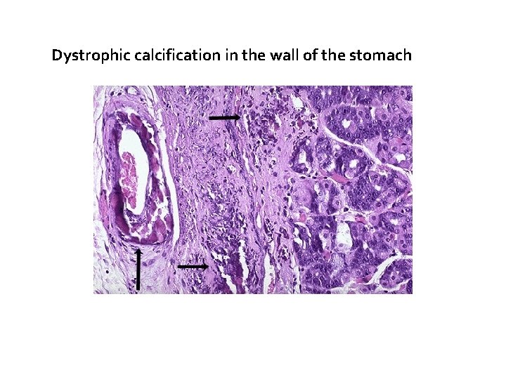 Dystrophic calcification in the wall of the stomach 