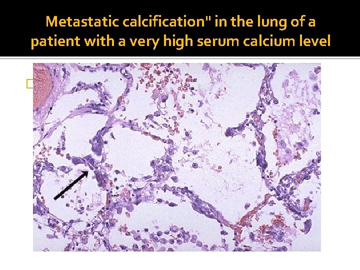 Metastatic calcification" in the lung of a patient with a very high serum calcium