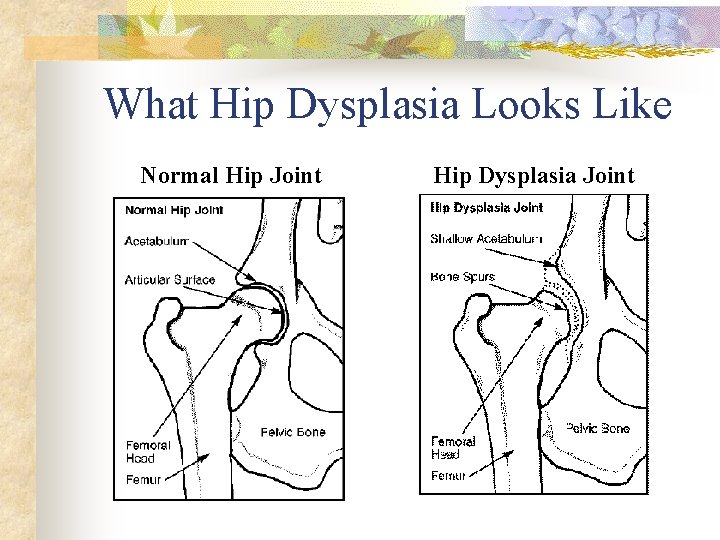 What Hip Dysplasia Looks Like Normal Hip Joint Hip Dysplasia Joint 