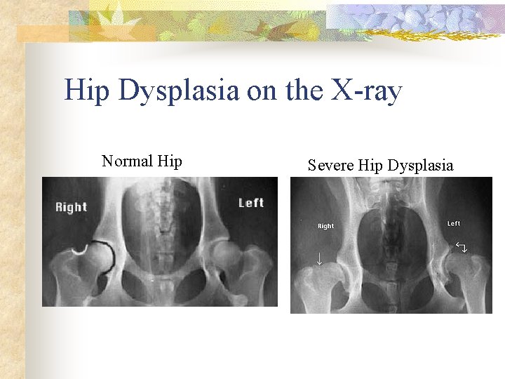 Hip Dysplasia on the X-ray Normal Hip Severe Hip Dysplasia 