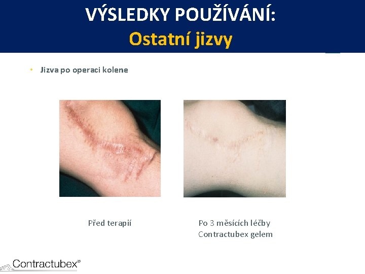 VÝSLEDKY POUŽÍVÁNÍ: Ostatní jizvy • Jizva po operaci kolene Před terapií Po 3 měsících