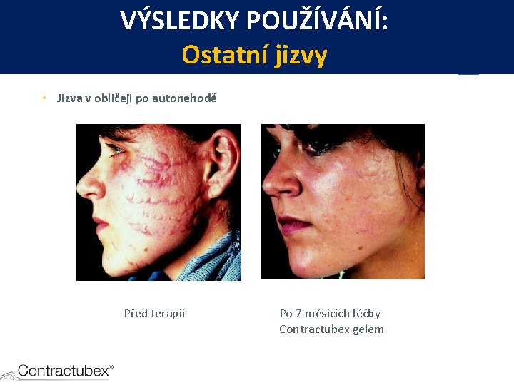 VÝSLEDKY POUŽÍVÁNÍ: Ostatní jizvy • Jizva v obličeji po autonehodě Před terapií Po 7