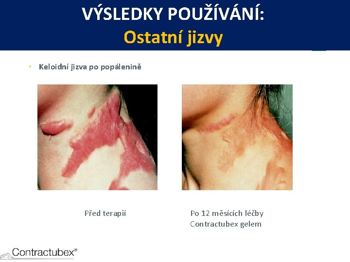 VÝSLEDKY POUŽÍVÁNÍ: Ostatní jizvy • Keloidní jizva po popálenině Před terapií Po 12 měsících