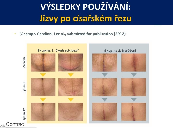 VÝSLEDKY POUŽÍVÁNÍ: Jizvy po císařském řezu • (Ocampo-Candiani J et al. , submitted for
