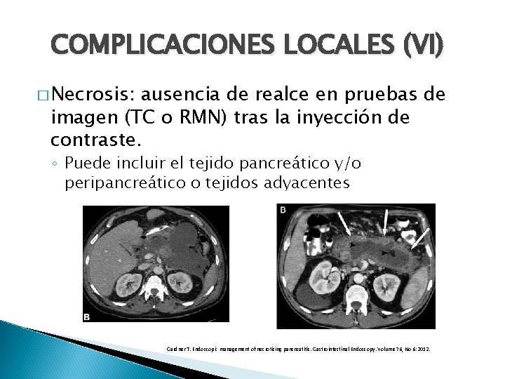 COMPLICACIONES LOCALES (VI) � Necrosis: ausencia de realce en pruebas de imagen (TC o