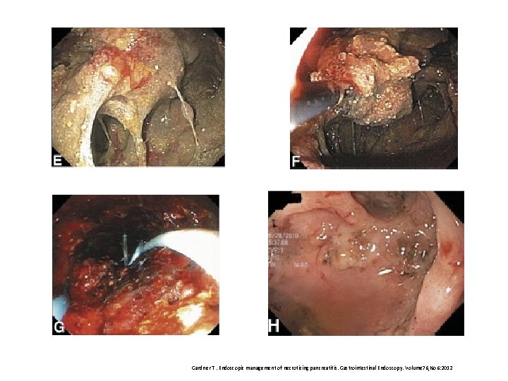 Gardner T. Endoscopic management of necrotizing pancreatitis. Gastrointestinal Endoscopy. Volume 76, No 6: 2012