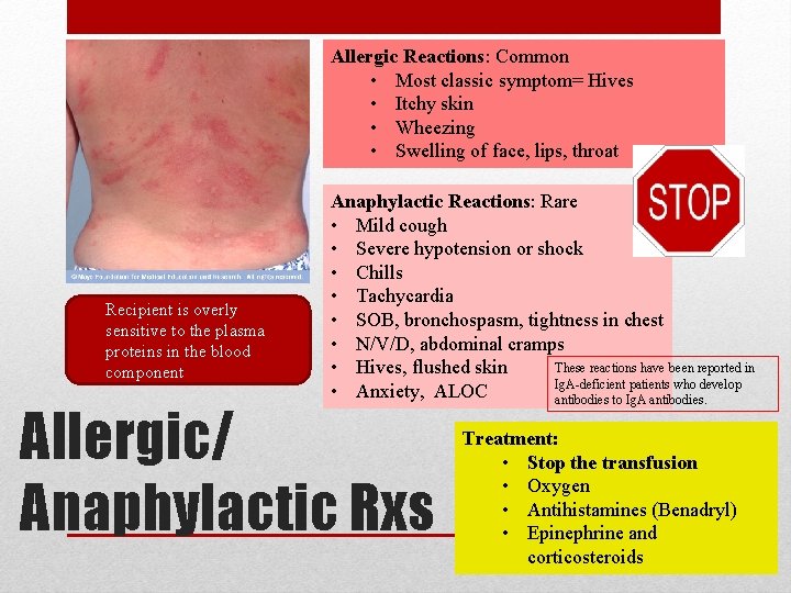 Allergic Reactions: Common • Most classic symptom= Hives • Itchy skin • Wheezing •