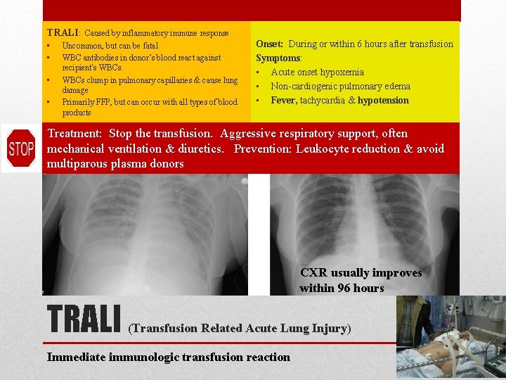 TRALI: Caused by inflammatory immune response • • Uncommon, but can be fatal WBC