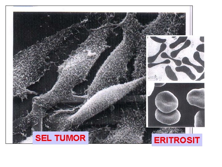 SEL TUMOR ERITROSIT 