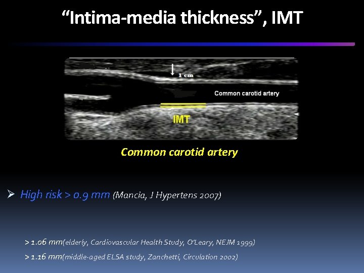 “Intima-media thickness”, IMT Common carotid artery Ø High risk > 0. 9 mm (Mancia,
