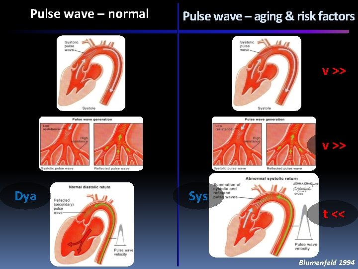 Pulse wave – normal Pulse wave – aging & risk factors v >> Dya