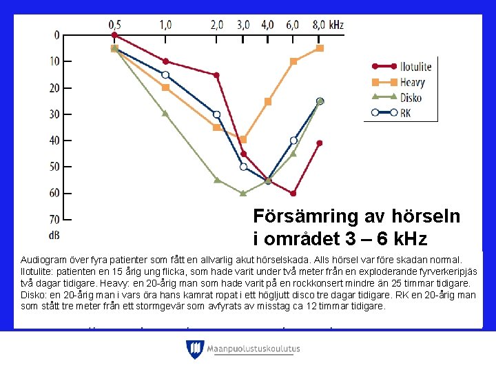 Försämring av hörseln i området 3 – 6 k. Hz Audiogram över fyra patienter