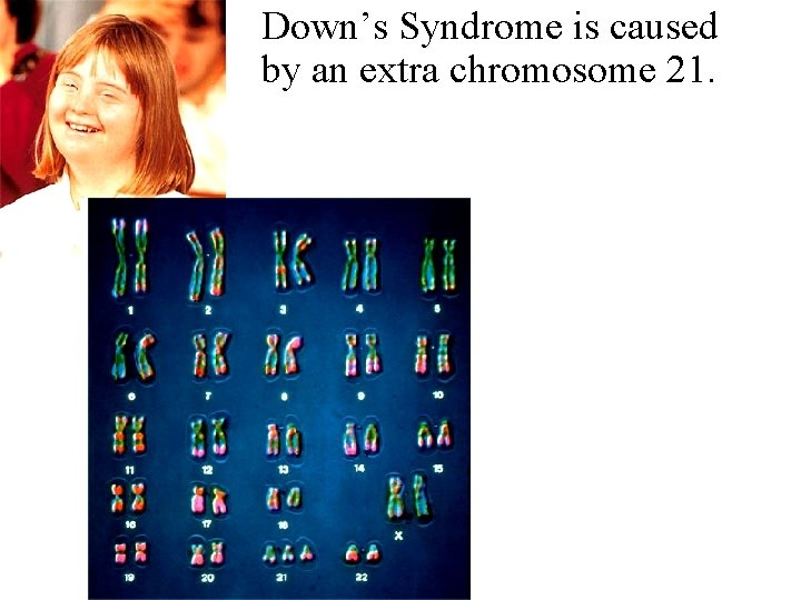 Down’s Syndrome is caused by an extra chromosome 21. 
