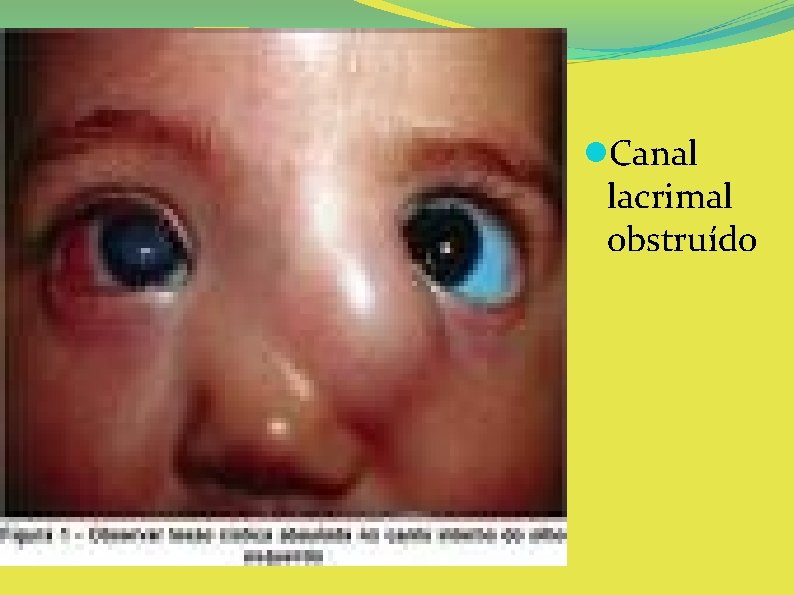  Canal lacrimal obstruído 