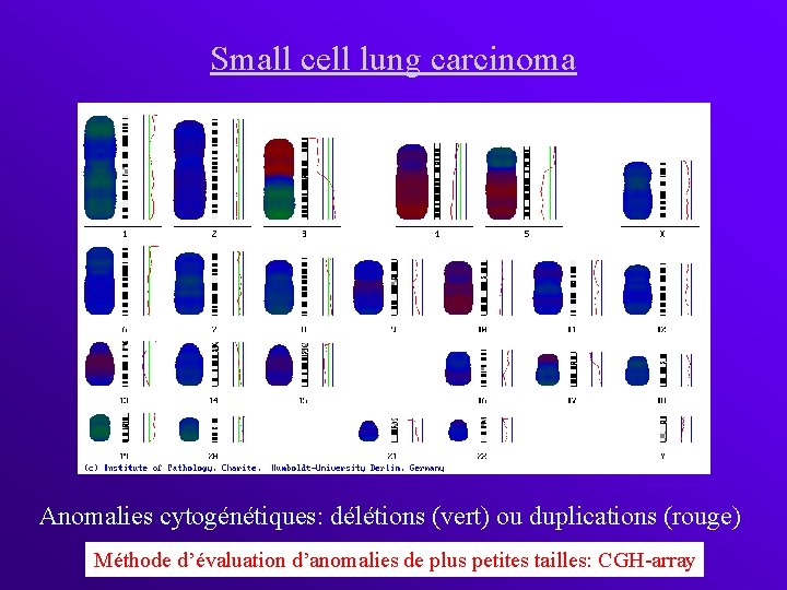 Small cell lung carcinoma Anomalies cytogénétiques: délétions (vert) ou duplications (rouge) Méthode d’évaluation d’anomalies