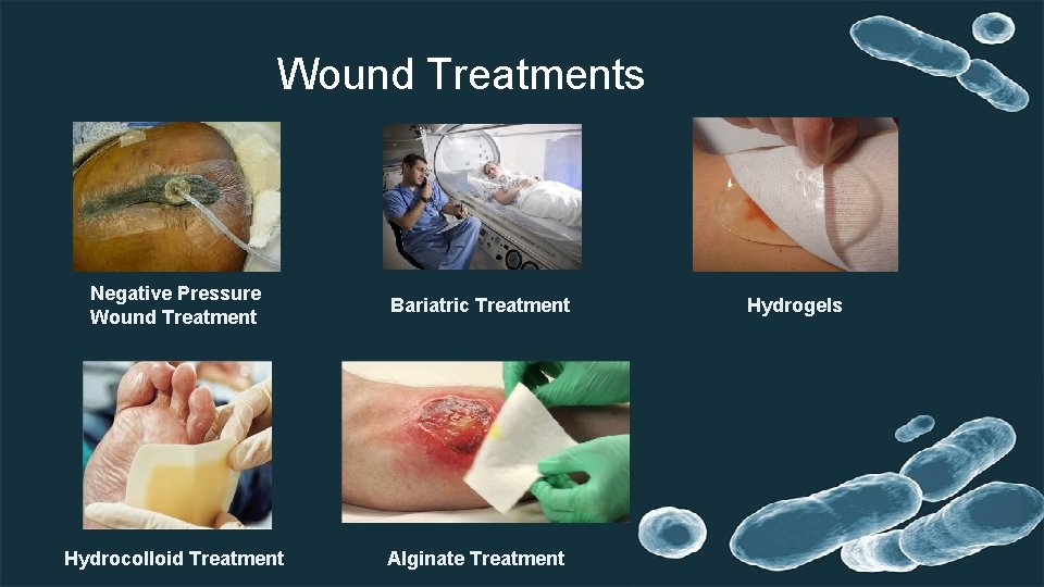 Wound Treatments Negative Pressure Wound Treatment Bariatric Treatment Hydrocolloid Treatment Alginate Treatment Hydrogels 