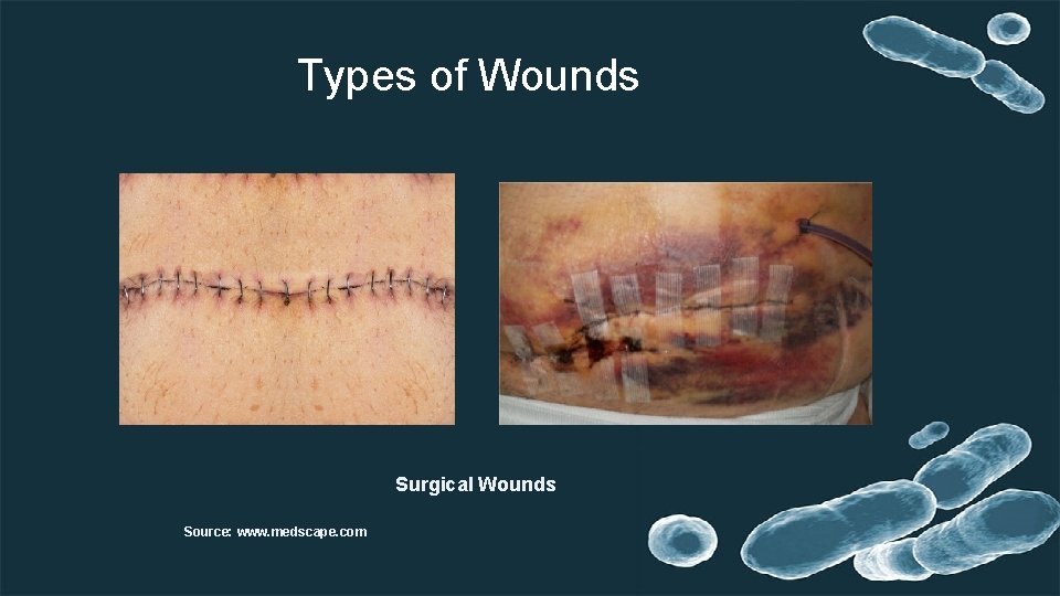 Types of Wounds Surgical Wounds Source: www. medscape. com 