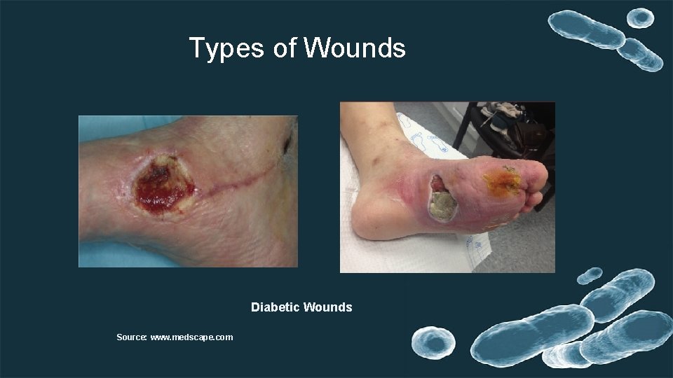 Types of Wounds Diabetic Wounds Source: www. medscape. com 