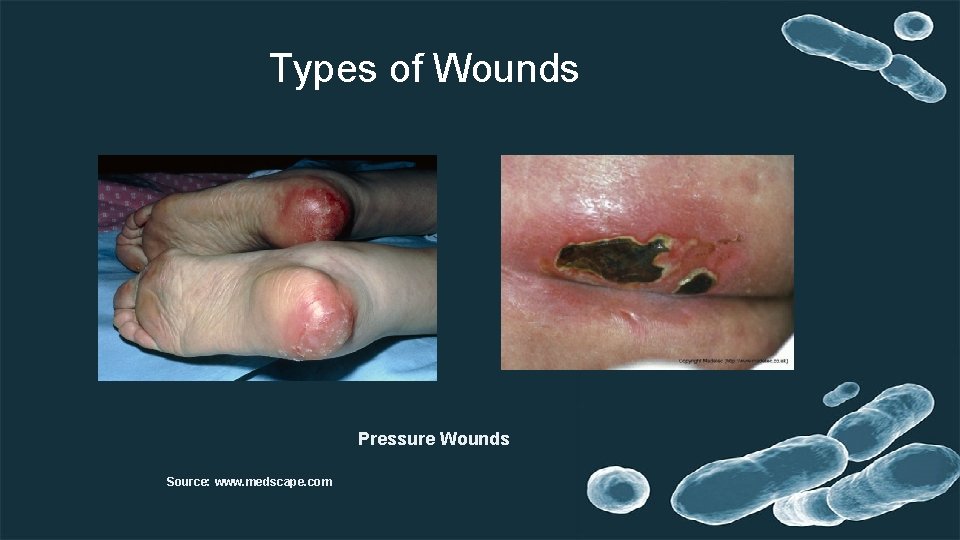 Types of Wounds Pressure Wounds Source: www. medscape. com 
