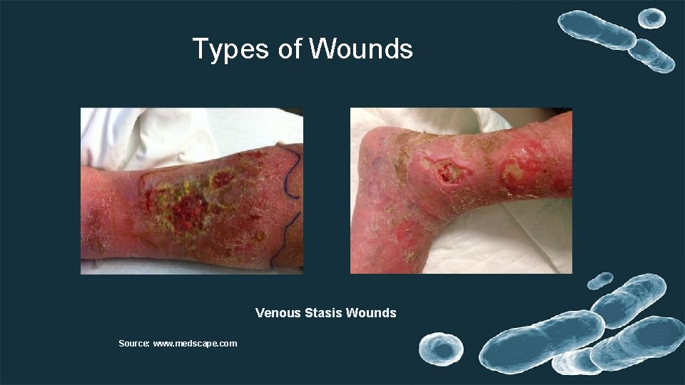 Types of Wounds Venous Stasis Wounds Source: www. medscape. com 