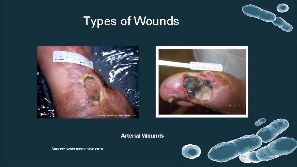 Types of Wounds Arterial Wounds Source: www. medscape. com 