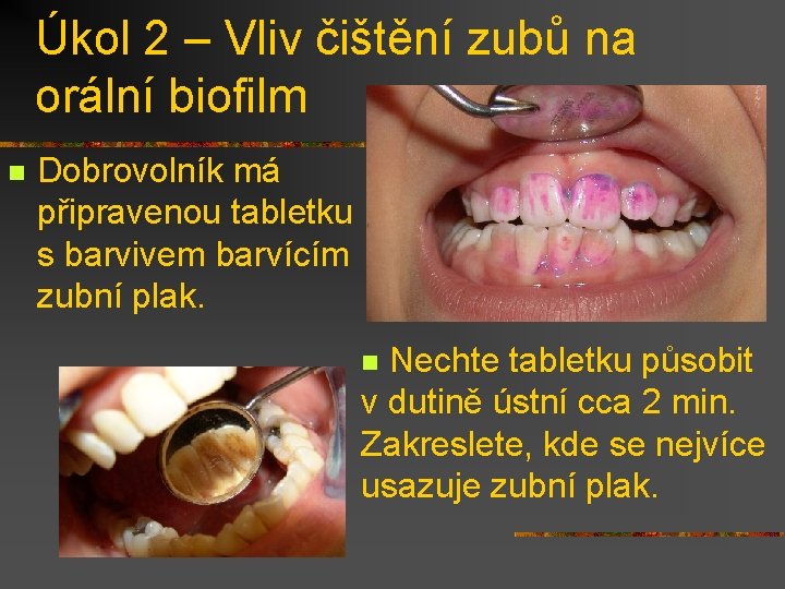 Úkol 2 – Vliv čištění zubů na orální biofilm n Dobrovolník má připravenou tabletku