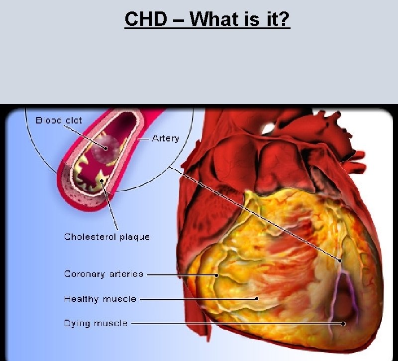 CHD – What is it? CHD – What is it?
