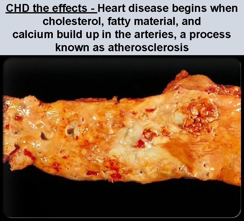 CHD the effects - Heart disease begins when cholesterol, fatty material, and calcium build CHD the effects - Heart disease begins when cholesterol, fatty material, and calcium build
