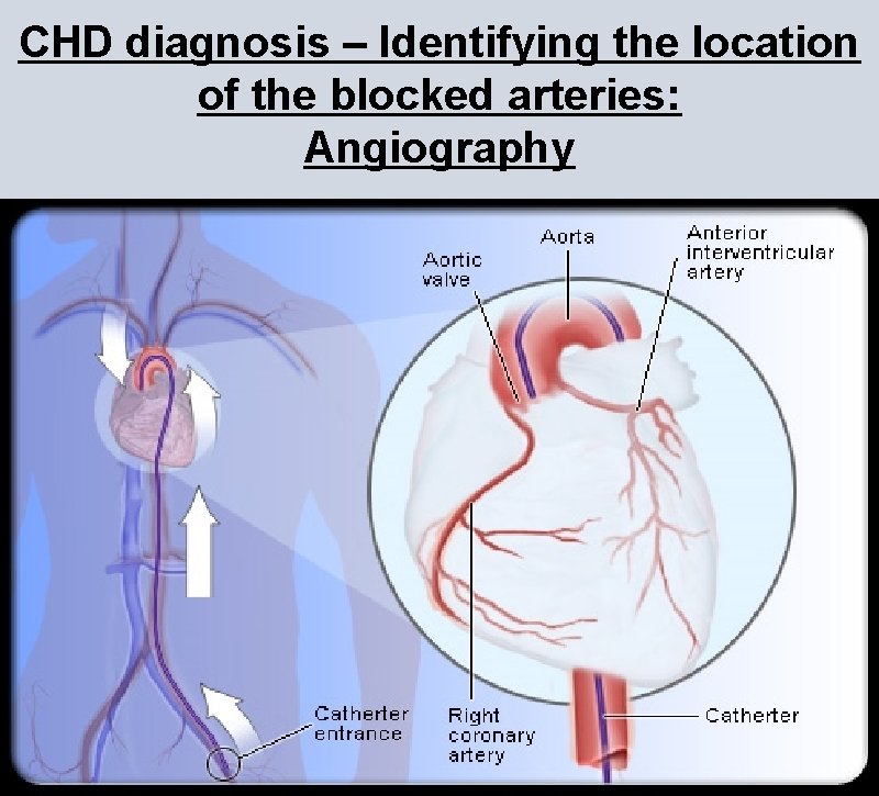 CHD diagnosis – Identifying the location of the blocked arteries: Angiography CHD diagnosis – Identifying the location of the blocked arteries: Angiography
