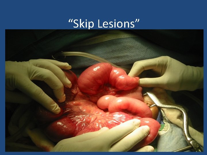 “Skip Lesions” 