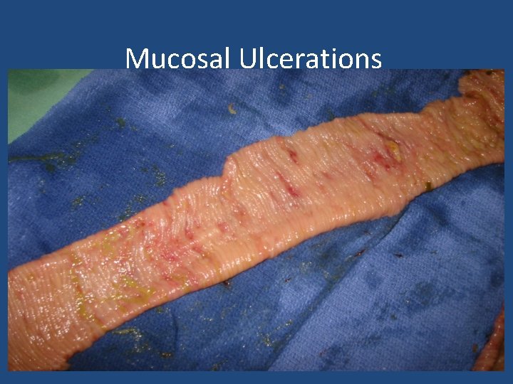 Mucosal Ulcerations 