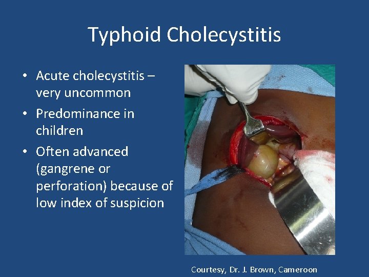 Typhoid Cholecystitis • Acute cholecystitis – very uncommon • Predominance in children • Often