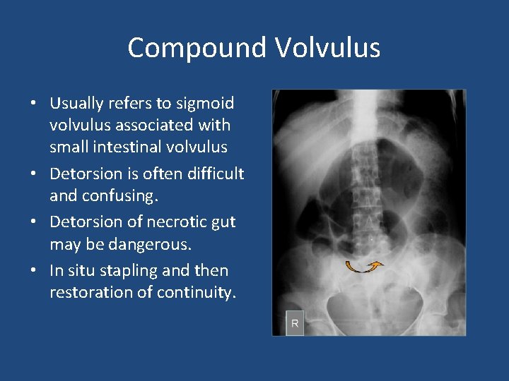 Compound Volvulus • Usually refers to sigmoid volvulus associated with small intestinal volvulus •