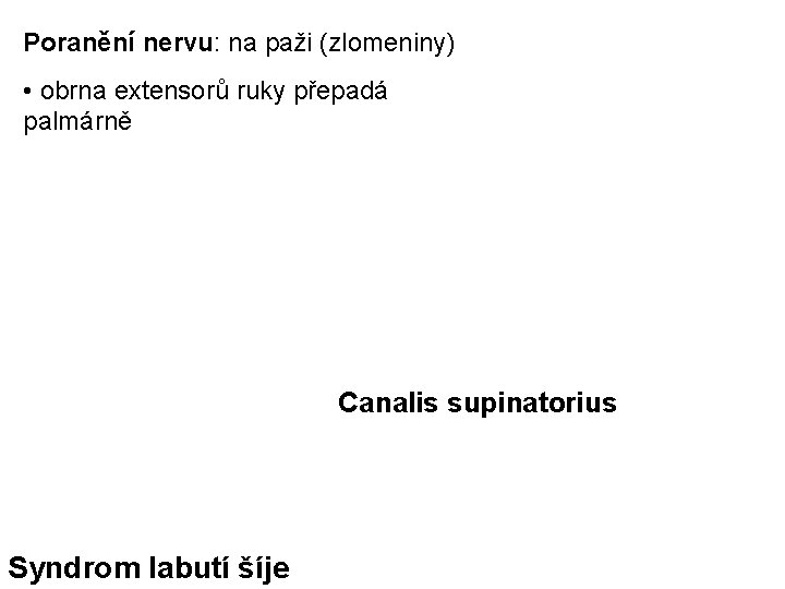 Poranění nervu: na paži (zlomeniny) • obrna extensorů ruky přepadá palmárně Canalis supinatorius Syndrom