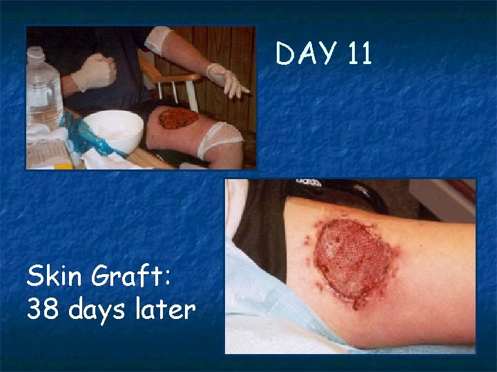 DAY 11 Skin Graft: 38 days later 