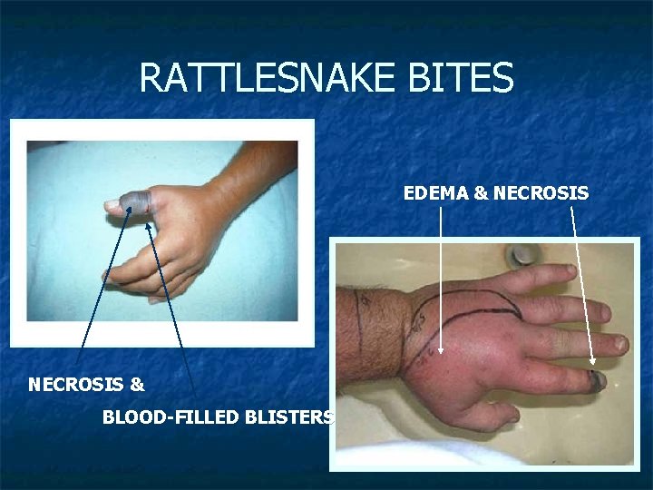BITES AND STINGS VENOM Hemotoxin Neurotoxin Local Tissue