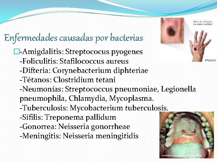 Enfermedades causadas por bacterias �-Amigdalitis: Streptococus pyogenes -Foliculitis: Stafilococcus aureus -Difteria: Corynebacterium diphteriae -Tétanos: