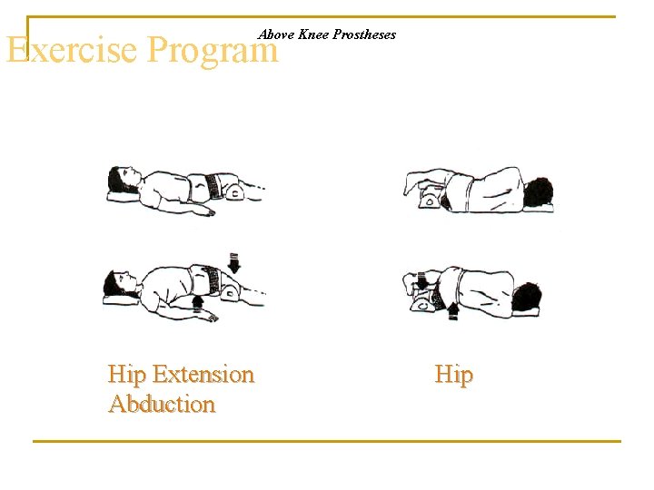 Above Knee Prostheses Exercise Program Hip Extension Abduction Hip 